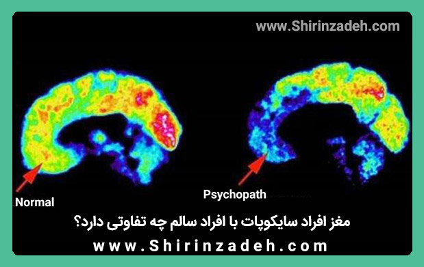 قشر جلوی مغز افراد سایکوپات ناهنجاری دارد.